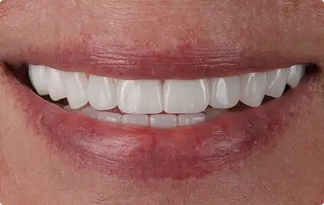 Close-up of a patient smile enhanced with a complete set of uniform, white teeth.