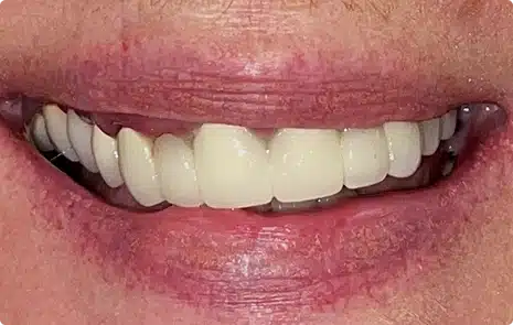 Close-up of a patient smile showing worn and discolored teeth.