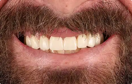 Close-up of a patient smile after restorative treatment with straighter, healthier-looking teeth.