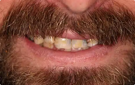 Close-up of a patient with chipped, discolored, and uneven front teeth.