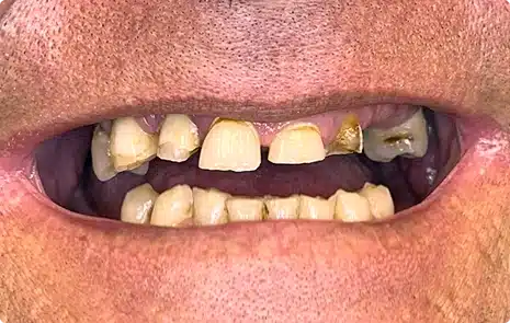 Close-up of a patient with multiple missing, damaged, and severely worn teeth.